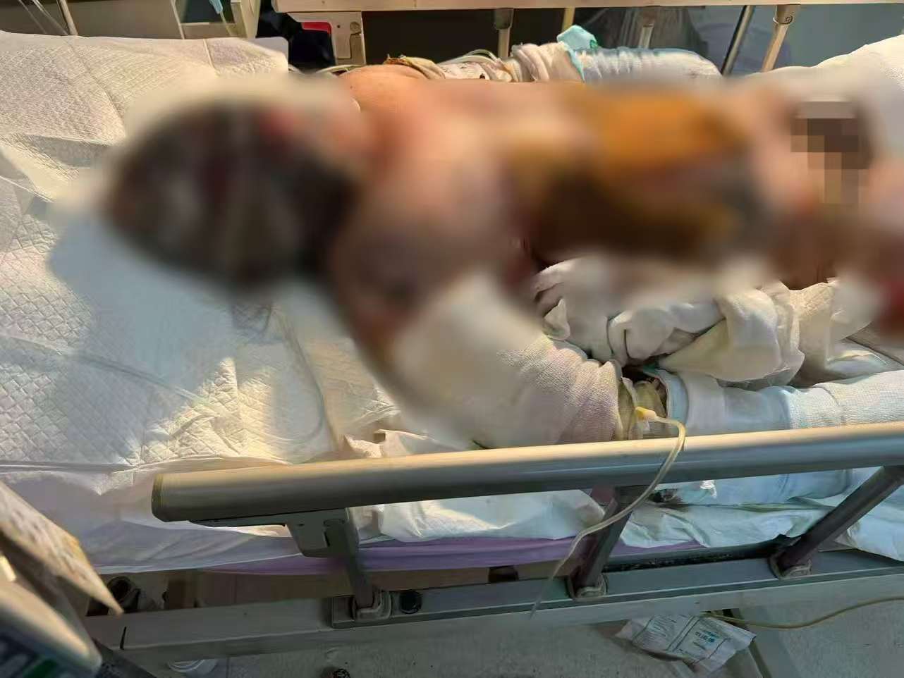 父子在哈尔滨一亲戚公司上班遇爆炸全身烧伤<strong></p>
<p>点差原油</strong>，治疗花费近百万公司拒赔偿？亲戚回应