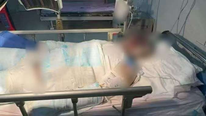 父子在哈尔滨一亲戚公司上班遇爆炸全身烧伤<strong></p>
<p>点差原油</strong>，治疗花费近百万公司拒赔偿？亲戚回应