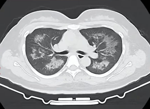 每天用2次<strong></p>
<p>丹阳有哪些证券公司</strong>，22岁女主播肺里长满阴影！很多人不注意