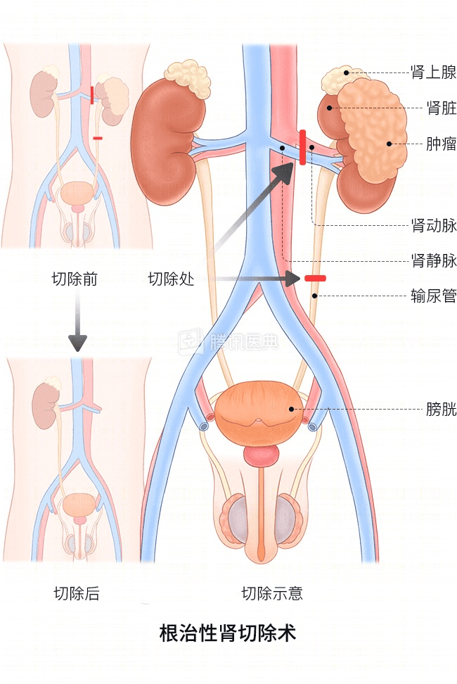“感觉天塌了”！深圳女孩5岁患癌<strong></p>
<p>证券公司员工开户</strong>，爸妈决定：为她冻存卵巢组织